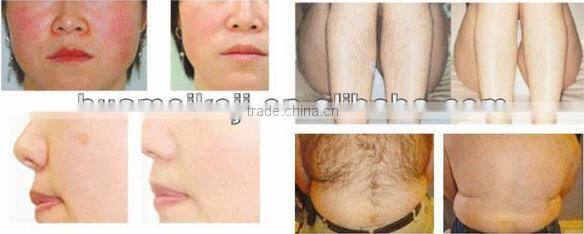dream women ipl machine ipl filters