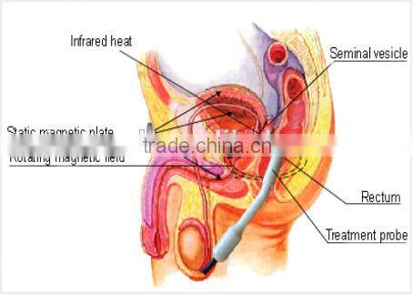 portable prostate therapy device BPH machine