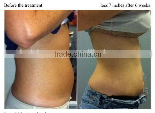 Criolipolisis Fat Freezing Slimming fat removal /Criolipolisis body slimming/ Criolipolisis Cryotherapy Machine