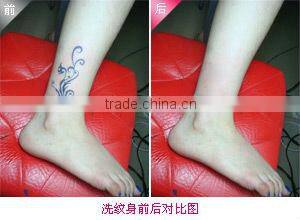 2013-2017 HOTTEST q-switch YAG laser tattoo removal laser machine (fast quickly best effective!!!)