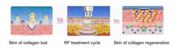fractional RF beauty equipment for skin lifting wrinkle removal