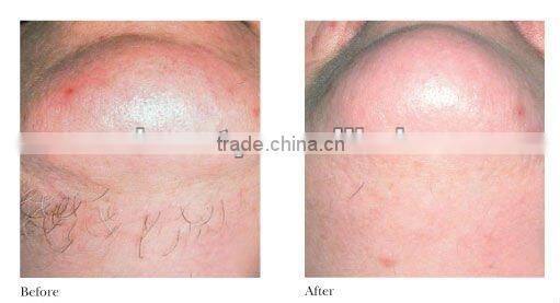 C001 photo epilator ipl handpiece epilation machine