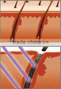 stationary high performance elight hair removal machine EROSE -YA