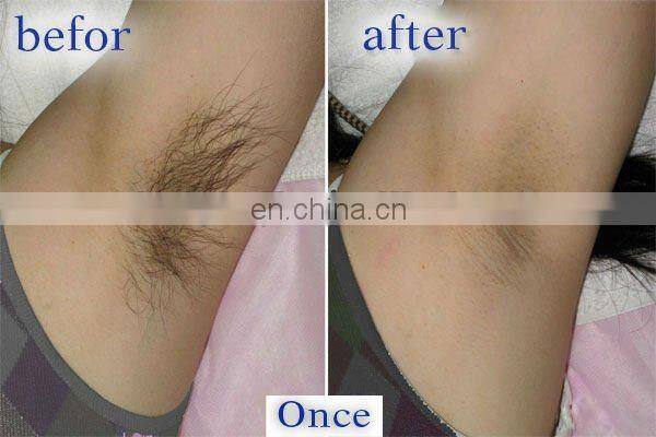 Professional 808nm diode laser hair removal machine