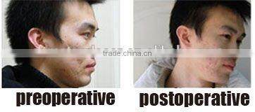laser yag / erbium yag laser / nd yag laser machine prices