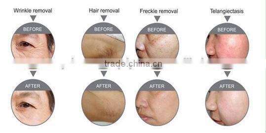 global sales ipl quantum laser hair removal hair reduction products