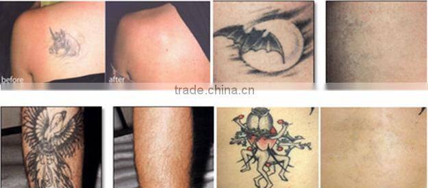 Professional laser hair and tattoo removal machine with best price