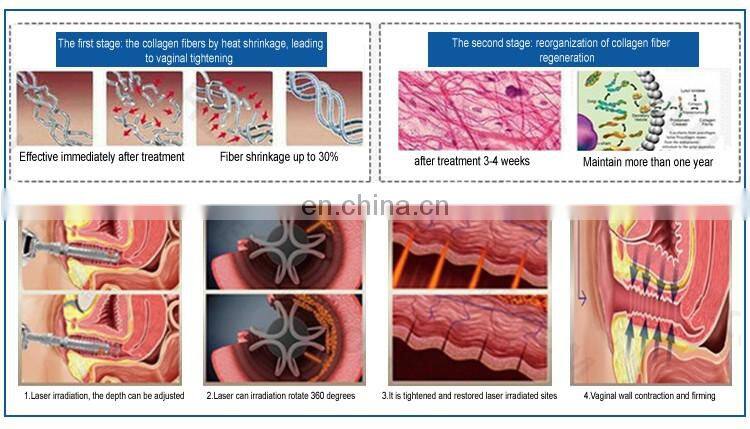 guangzhou renlang fractional laser co2 fracionado vaginal tightening machine for sale