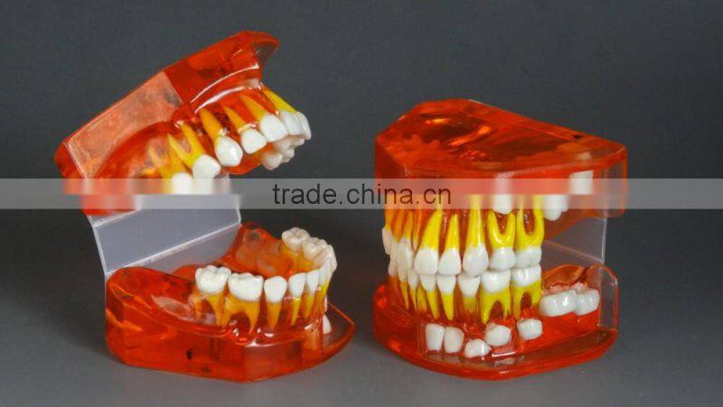 Bicolor Deciduous Teeth Development Model 1Teaching Demonstration Models