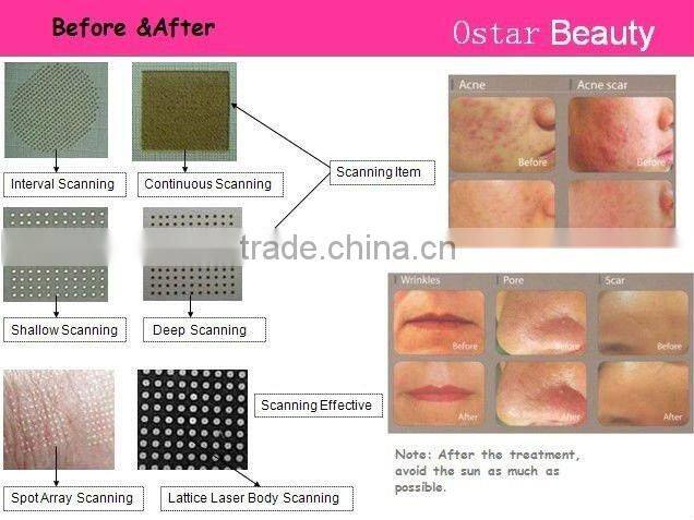 Super co2 laser fractional system for scar removal skin care OB-FC 01