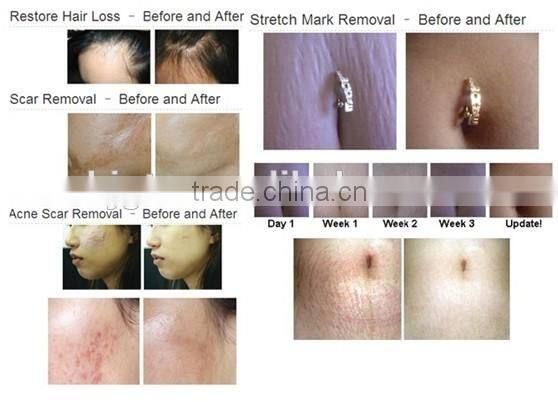 Derma roller/high quality titanium Needles Dermaroller