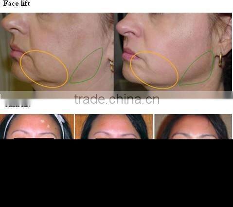 Factory OEM supply CE approved RF thermacool beauty machine with 7 polar rf handle for facial&body skin lifting