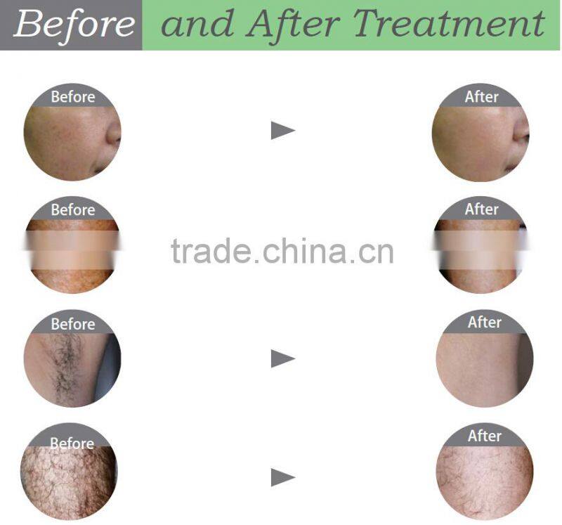 Painess fast super permanent hair removal machine Ipl shr e-light laser hair removal machine for sale