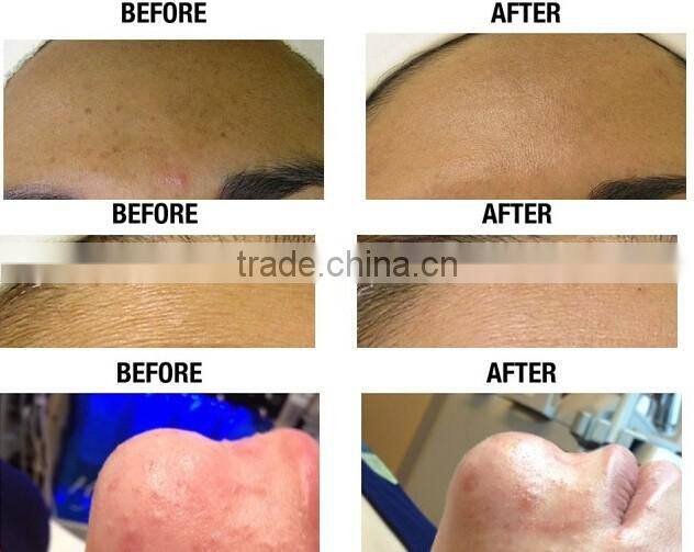 Hot saleJJet peel water oxygen skin rejuvenation machine oxygen injection jet peel multifunctional oxygen jet