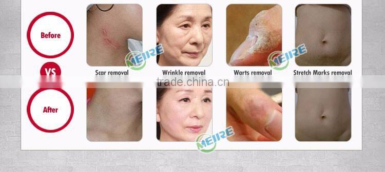 Factory price CE approved fractional co2 laser scar removal co2 fractional laser therapy