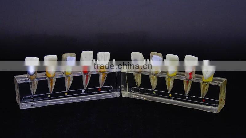 Endodontics disease dental demonstration model 1 DEA-49