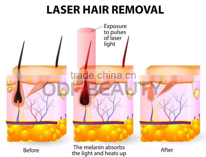 OD-LS808 Best selling hot painless depilation 808 diode laser machine