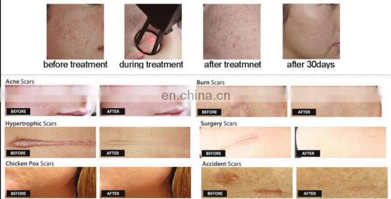 Factory price of fractional co2 laser vaginal tightening pigmentation correctors machine for spa use