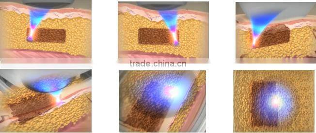 Hot new product hifu machine cryo hifu machine cryo liposunix for clinic use