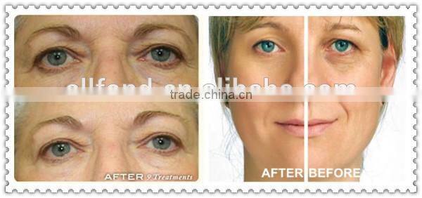 Allfond skin tightening machine for home use