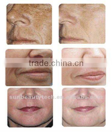 Oxygen Jet+ Needle-free Beauty Machine