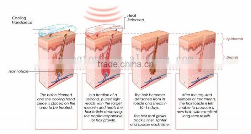 808nm diode hair removal laser personalization machine