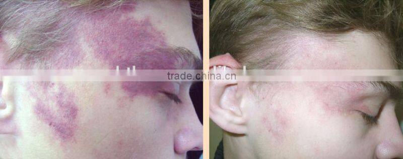 MBT 980nm diode laser for vascular lesions and spider veins machine