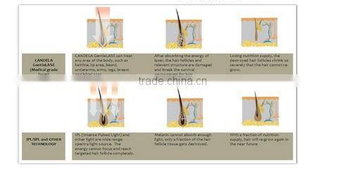 laser hair removal portable 808nm diode laser permanent hair removal device