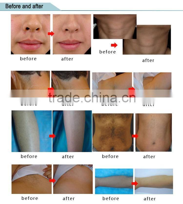 Big spot size portable diode laser 810 hair removal machine/ laser hair removal machine