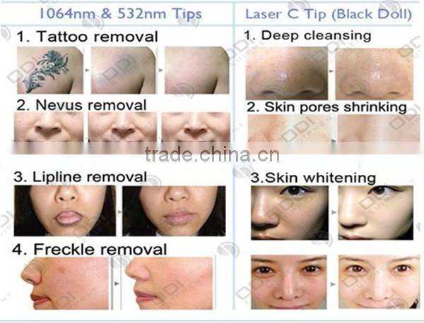 2015 OD-LS450 Multifunction Beauty Machine tattoo removal portable nd yag q switch mini laser nevus removal machine