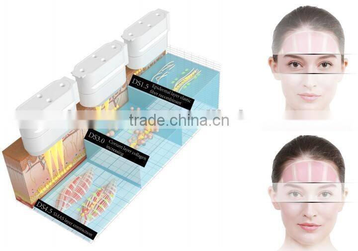 hifu high intensity focused ultrasound / hifu portable / hifu 2015