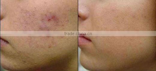 Hot salable skin vibrating derma roller for import