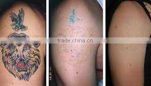 professional laser tattoo removal machine/ce approved tattoo removal lasers/laser tattoo removal device