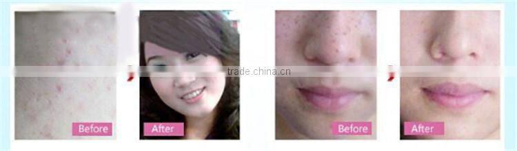 Needle free mesotherapy multipolar rf facial wrinkle treatment machine for sale