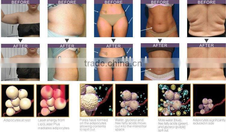 best laser diode effective slimming machine LP-01/CE i lipo laser for body slimming