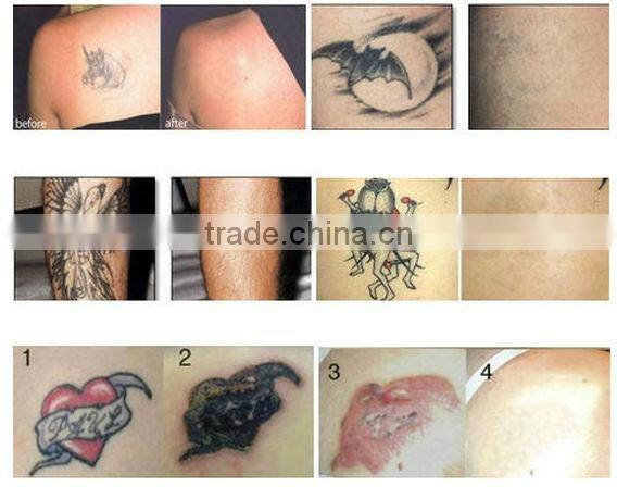 7 Mirror Articulated Arm 1064nm 532nm 1055nm Q Switched Nd YAG Tattoo Remover Laser