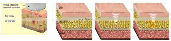 2016 newest high intensity focused ultrsound slimming HIFUSHAPE Hifu