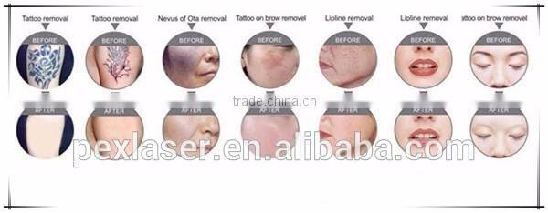 Hair removal and tattoo removal elight nd yag laser machine P-303