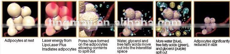 TM-909 portable lipo laser for sale portable lipolaser slimming machine price lipolaser