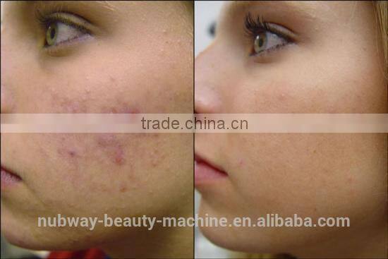 30000 Hours Long Life Time American RF Tube CO2 Fractional Laser