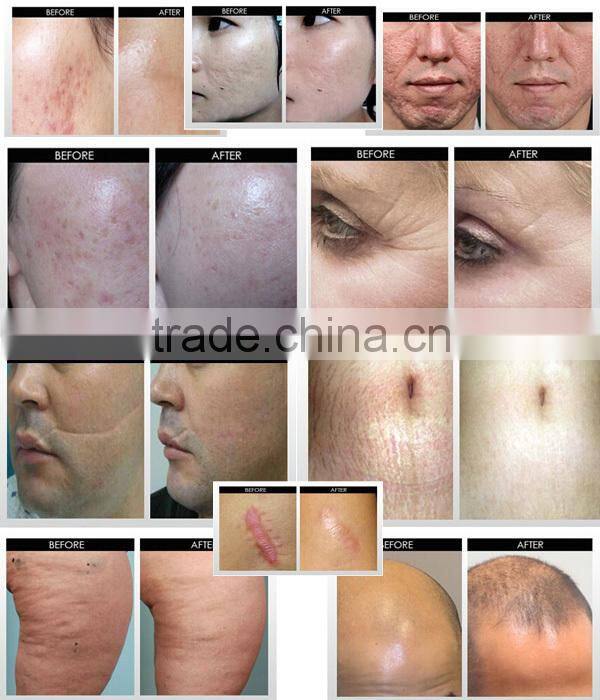 Factory Price Biogenesis Dns Titanium Derma Roller 192 microneedle machine