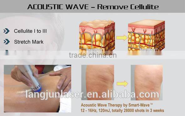 easthetic acoustic wave cellulite removal shockwave therapy machine
