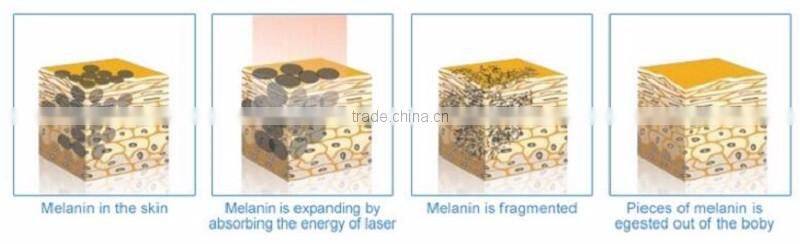 ND: Yag Laser Tattoo Removal Machine Hot Sale in Hanoi Vietnam