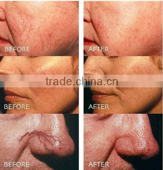 Immediately Result 980nm diode laser spider veins facial redness removal RBS03