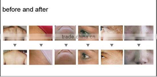 3in1 YAG LASER + IPL + RF Smooth SKIN hair Removal E11b