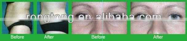 2015 best selling machine smart lipo machine laser cutting machine