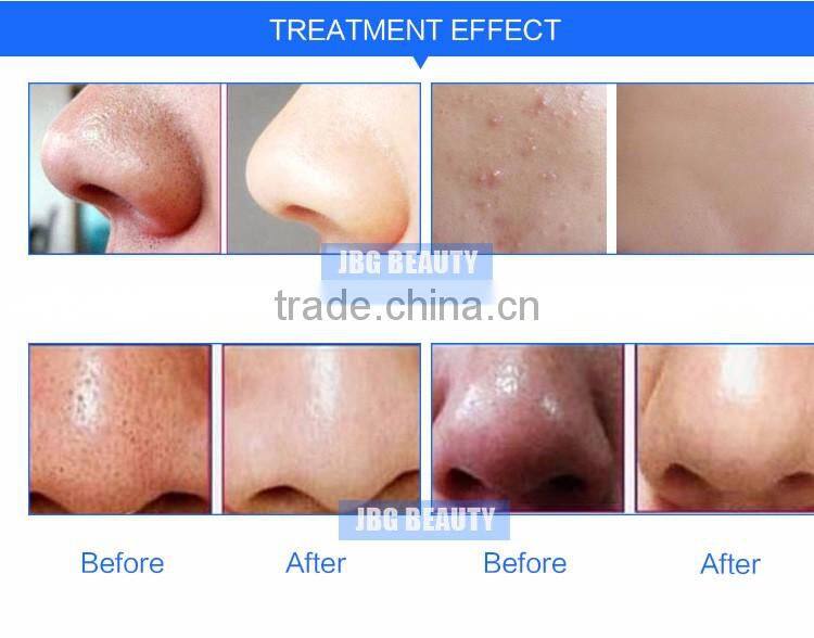 Handheld mini crystal diamond dermabrasion machine/ microdermabrasion tip machines for sale