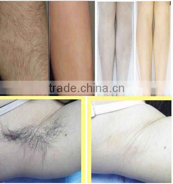 Hot sale IPL SHR Hair Removal xenon lamps 150w