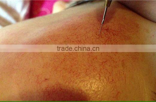 Laser /e-light/High frequency/ ipl vascular lesions removal