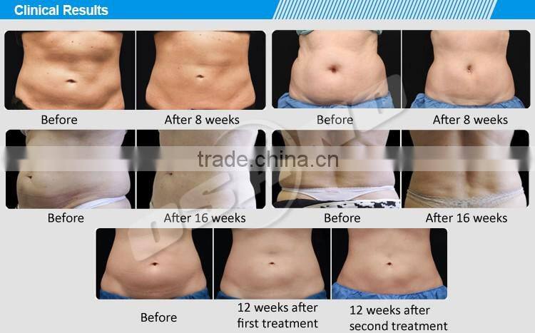 Cryolipolysis Slimming Machine 4 Handles Cryotherapy